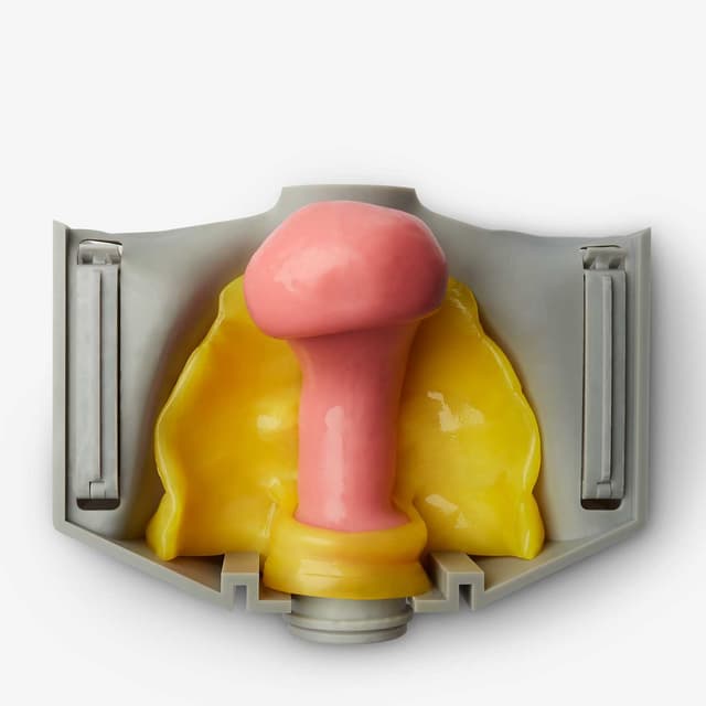 Hysterectomy Class II