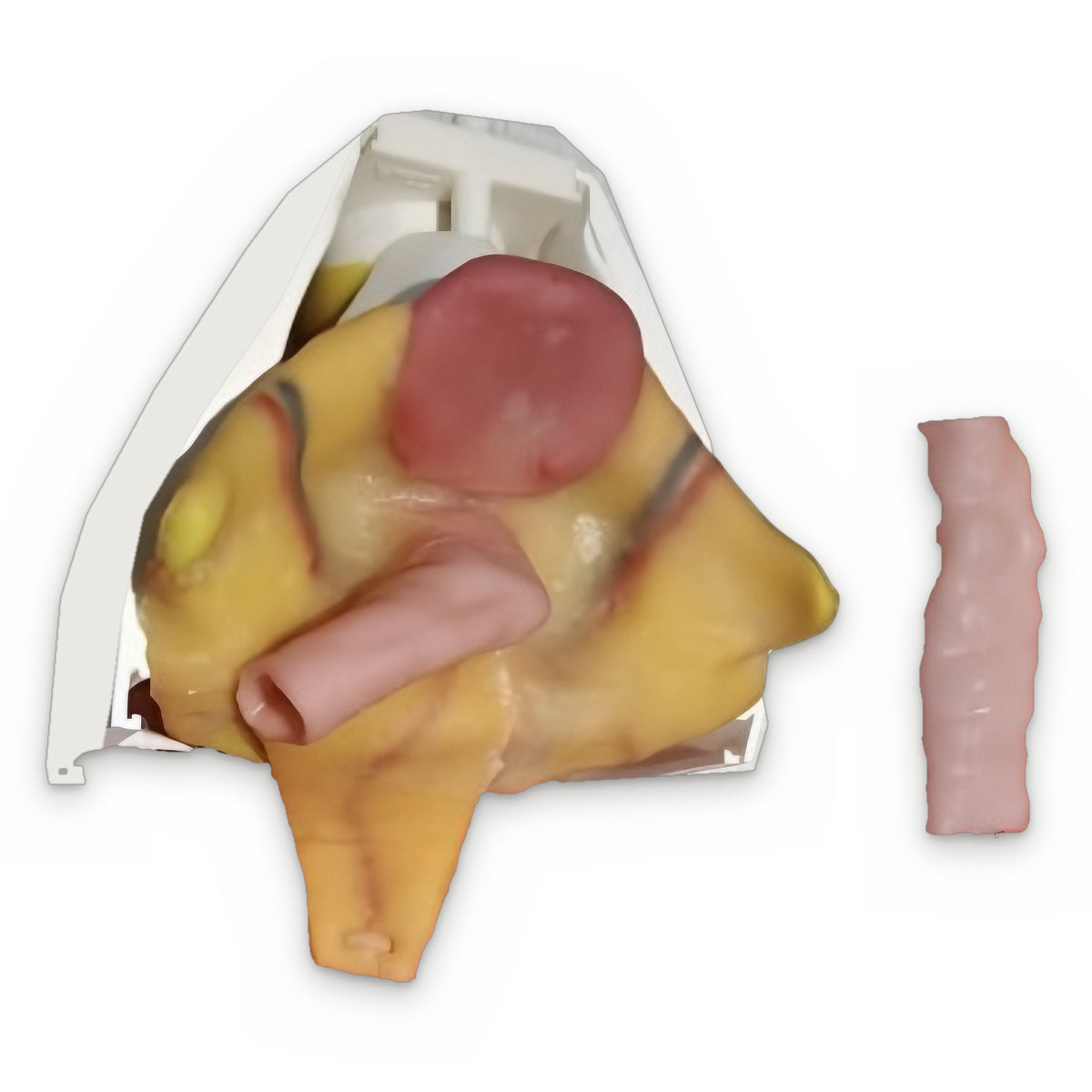 Total Mesorectal Excision (Class IV)