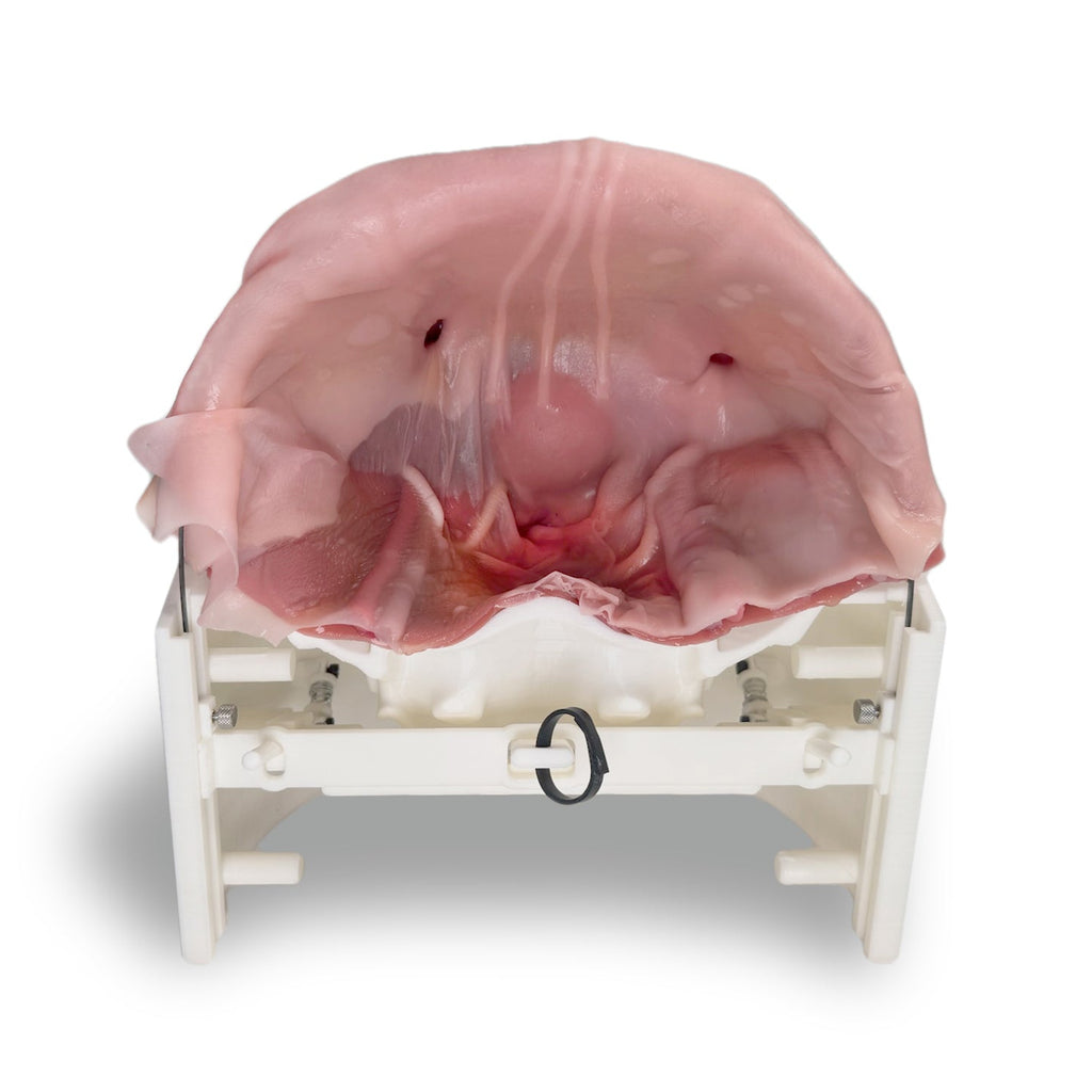 Inguinal Hernia (Class IV)