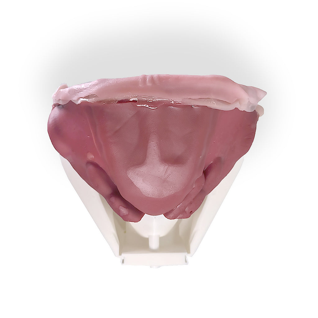 Inguinal Hernia (Class IV)