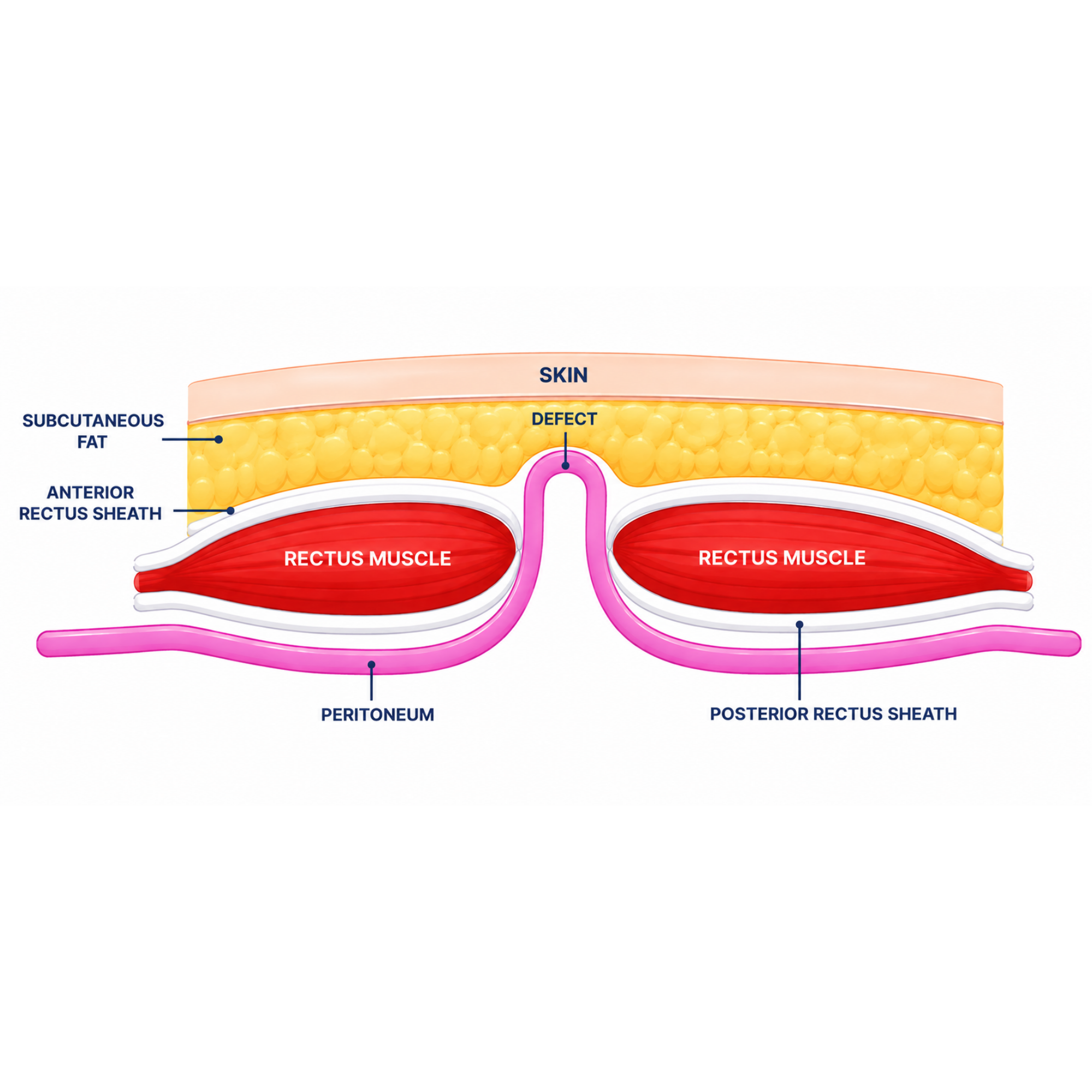 Ventral Hernia (Class II)